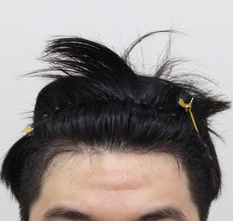 4. 수술후_5개월_1.JPG