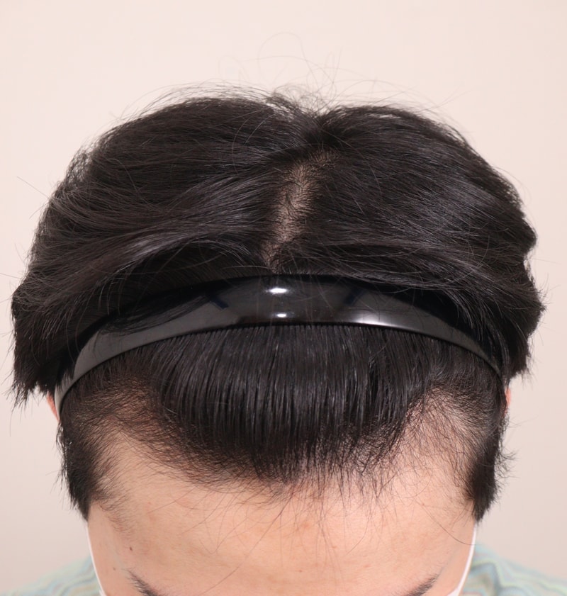 1. 수술전_2.JPG