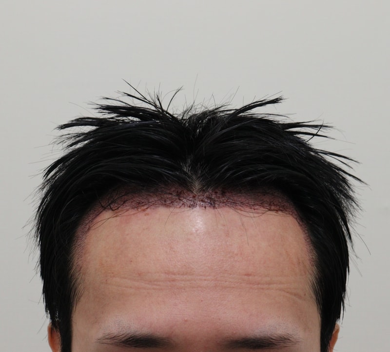 2. 수술후_1일_1.JPG