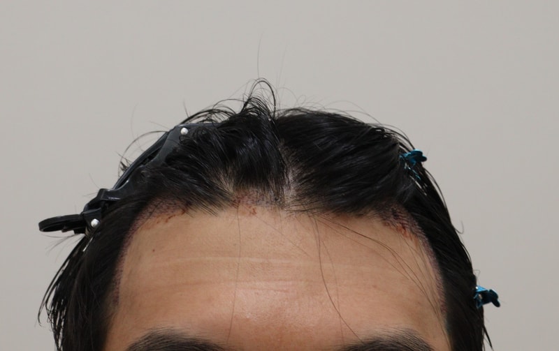 2. 수술후_1일_1.JPG