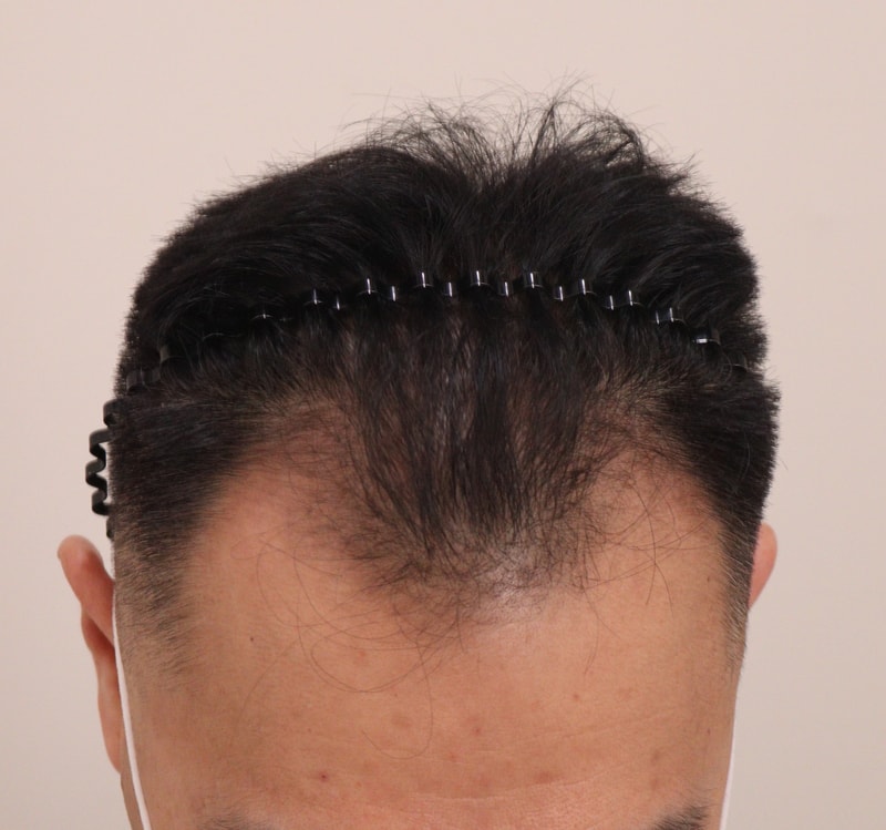 1. 수술전_2.JPG