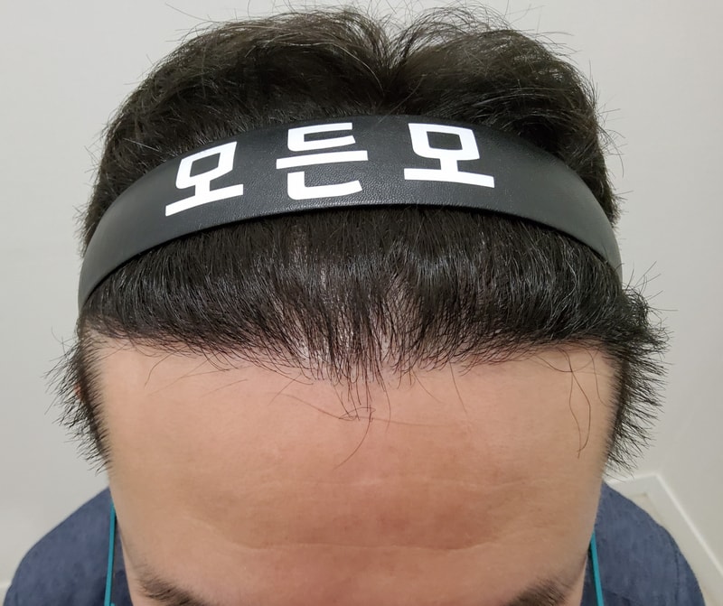4. 수술후_1년_1.jpg