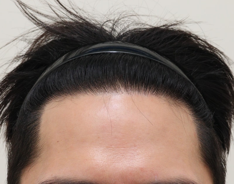 4. 수술후_1년_1.JPG