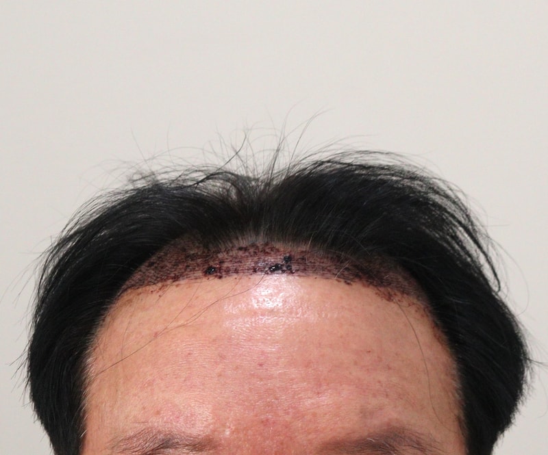 2. 수술후_1일_1.JPG