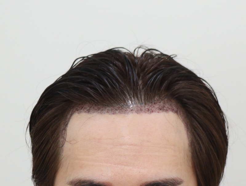 2. 수술후_1일_1.JPG
