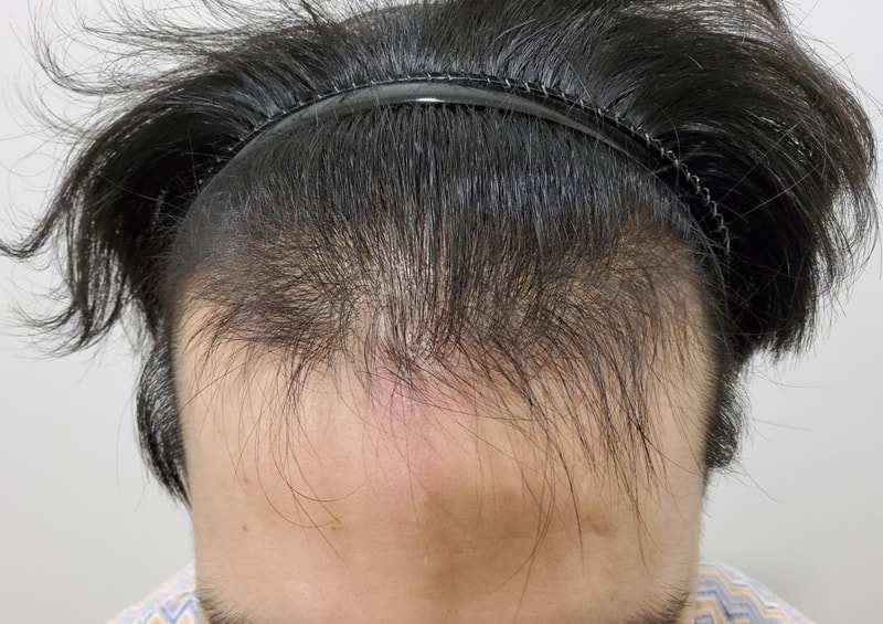 모발이식 3개월! 확실히 변했죠??