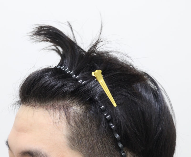 4. 수술후_5개월_2.JPG