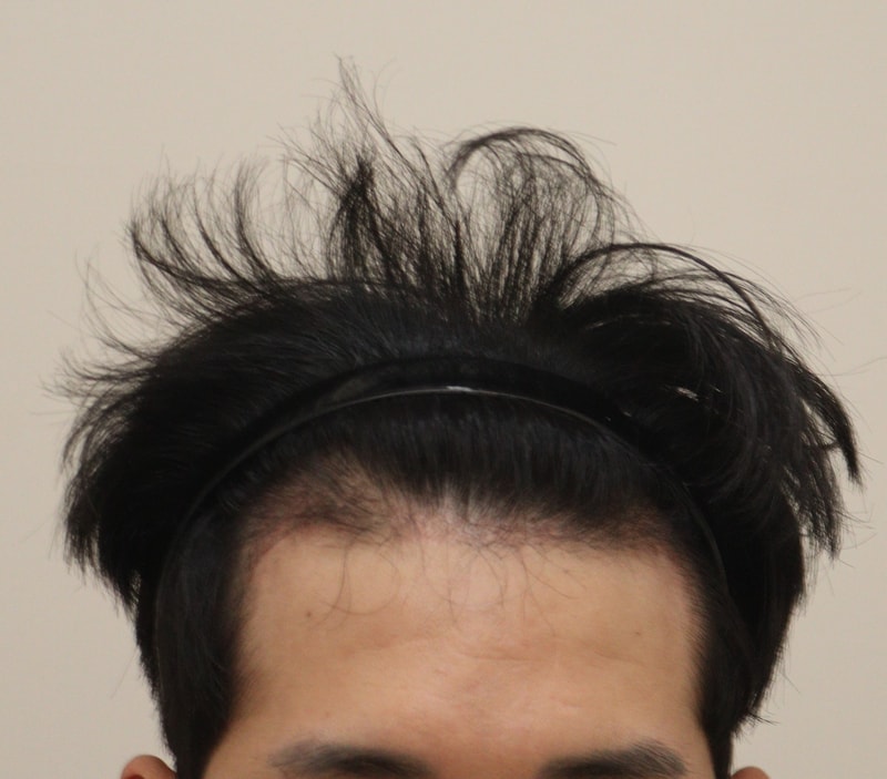 3. 수술후_3개월_1.JPG