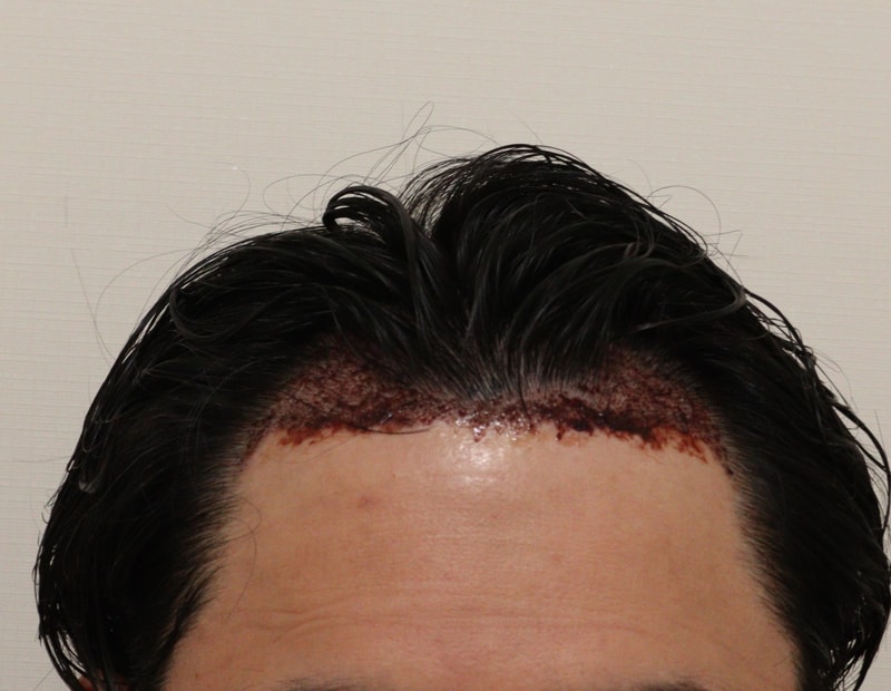 2. 수술후_1일후_1.JPG