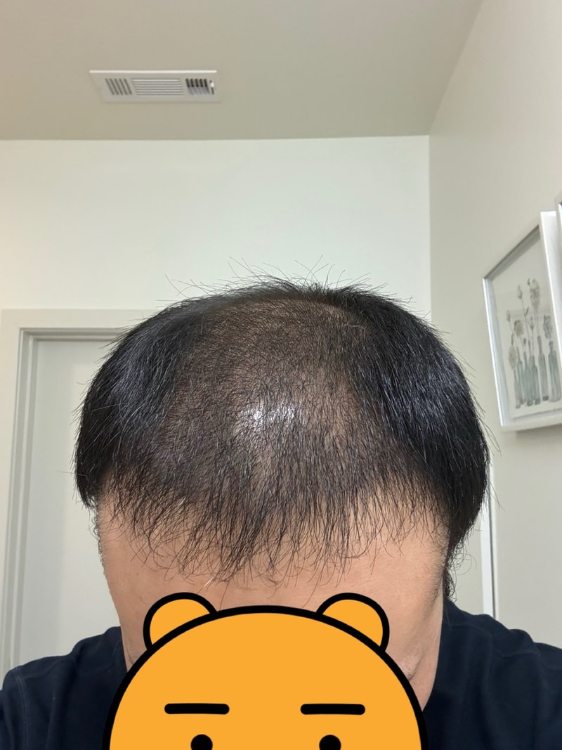 3. 수술후_3개월_셀카_2.jpg