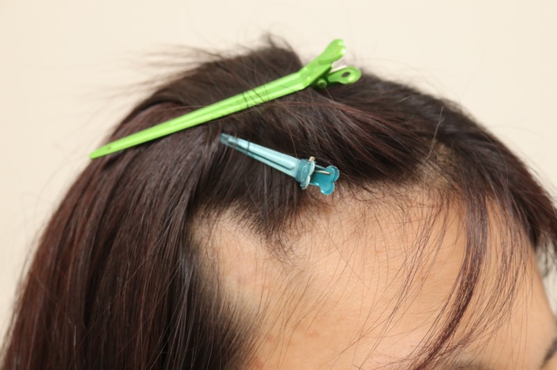 흉터부분 이식한거 다 채워지고 있어요 ㅎ