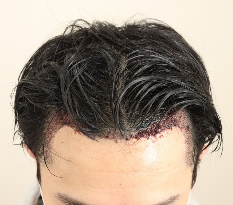 2. 수술후_1일.JPG