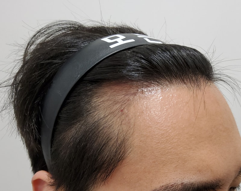 3. 수술후_3개월_3.jpg