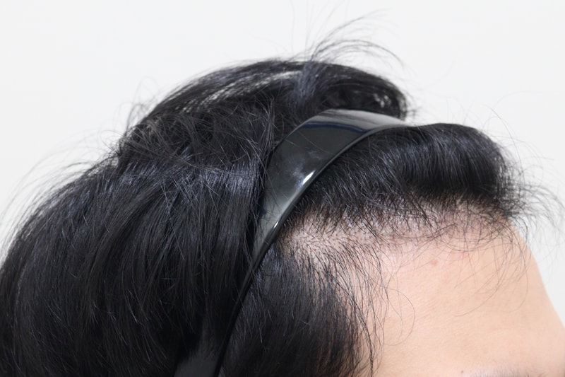 2. 수술후_7개월_3.JPG