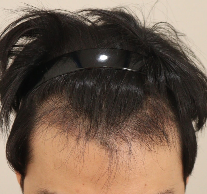 3. 수술후_3개월_2.JPG