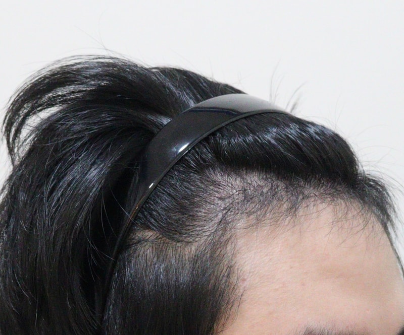 4. 수술후_6개월_2.JPG