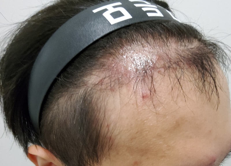 3. 수술후_3개월_3.jpg