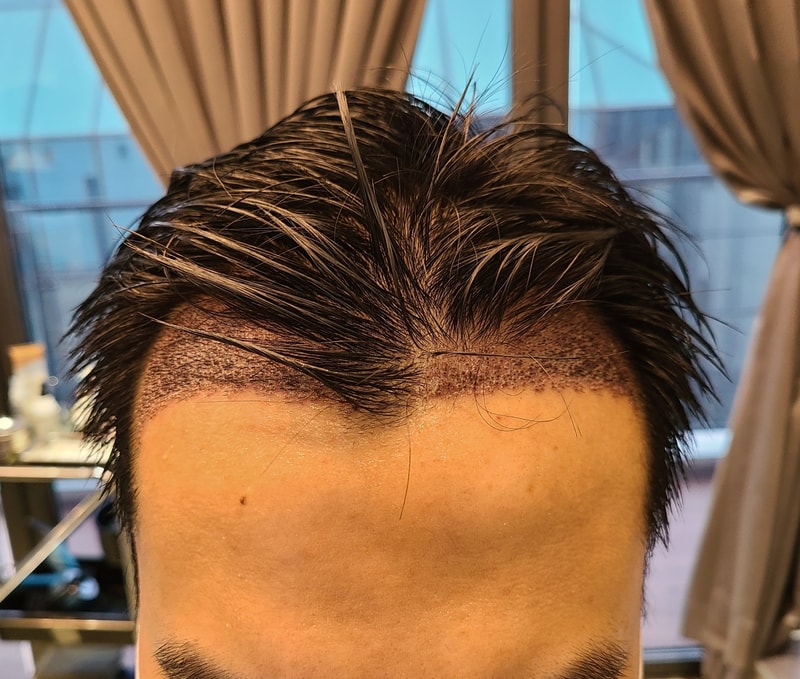 1. 수술후_1일_1.jpg