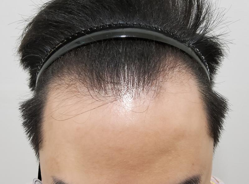 This is the first year review of non-cutaneous hair transplantation!