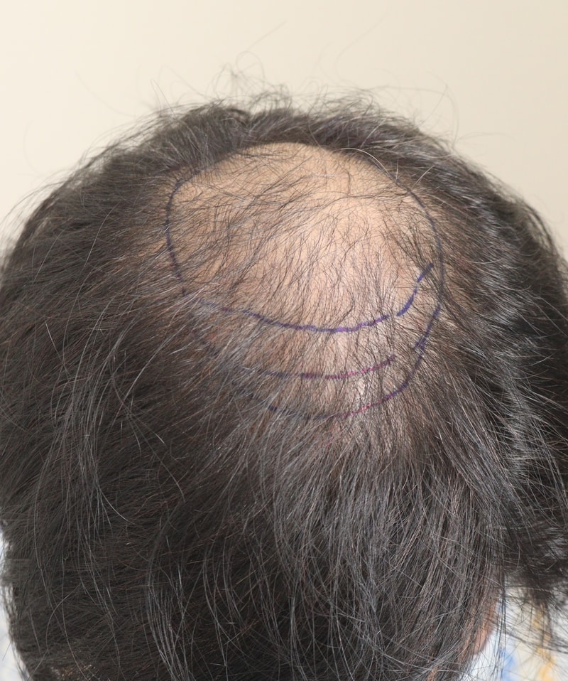 어제 비절개로 6300모 이식받았습니다~