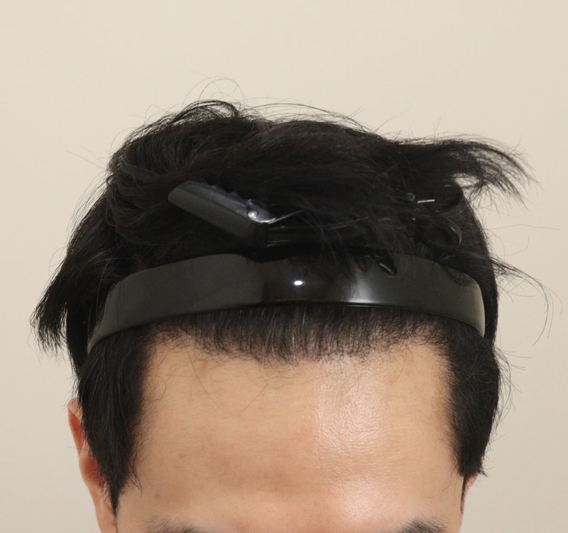 4. 수술후_6개월_2.JPG