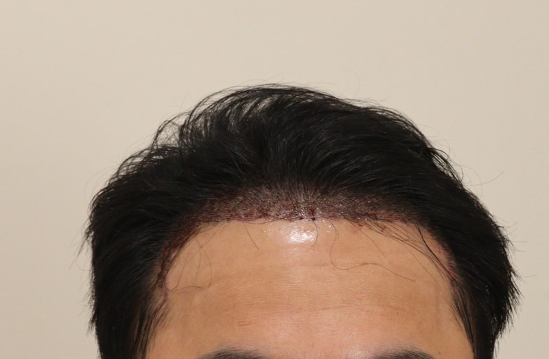 1. 수술후_1일_1.JPG