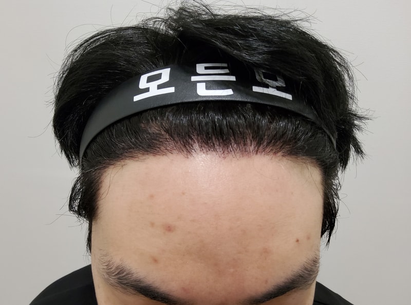3. 수술후_1년.jpg