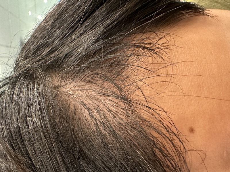 3. 수술후_3개월_셀카_2.jpg