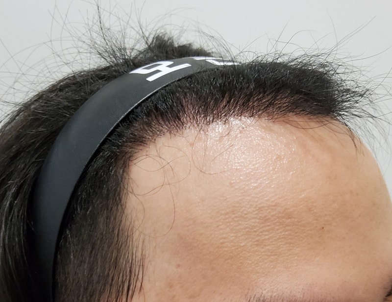 5. 수술후_6개월_3.jpg