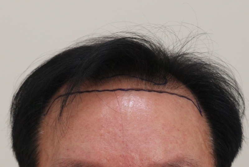 딸내미 덕분에 모발이식 받았습니다