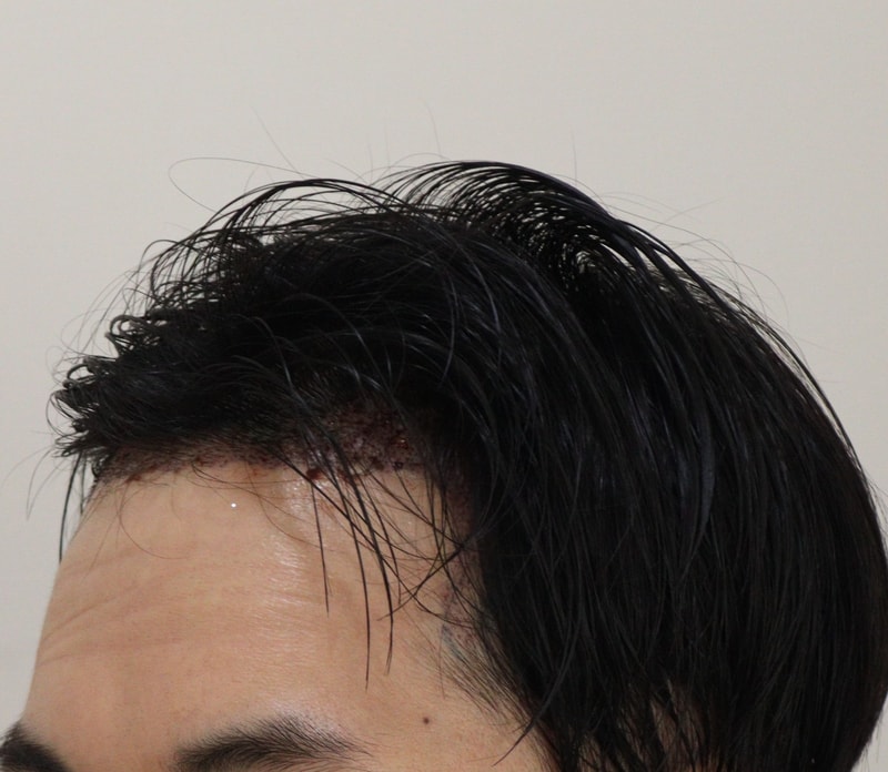 2. 수술후_1일_2.JPG