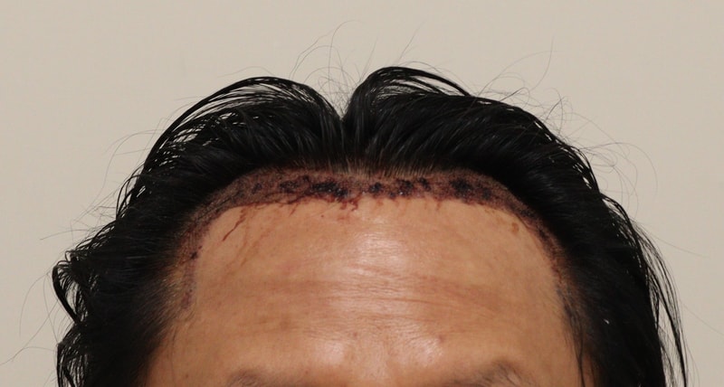2. 수술후_1일.JPG