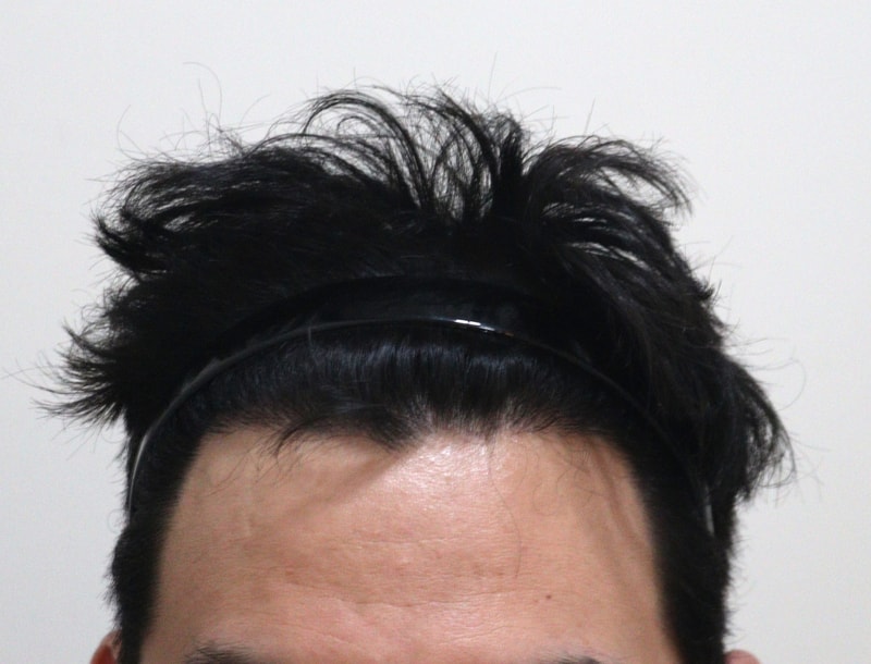 4. 수술후_7개월_1.JPG