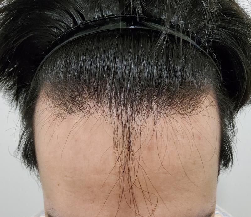 비절개 모발이식 6개월 지났습니다