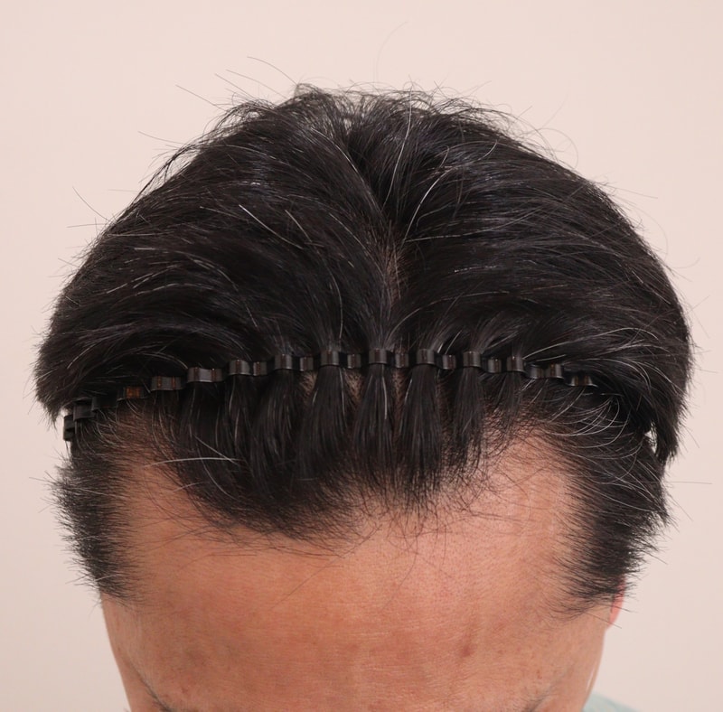 1. 수술전_2.JPG