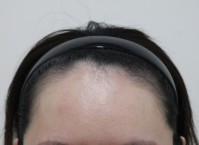 모앤블레스에서 헤어라인 이식받은지 6개월 됐습니다 :)