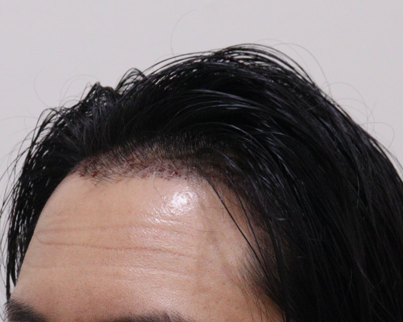 2. 수술후_1일_2.JPG