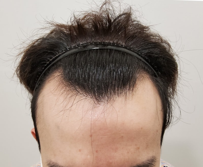 드디어 모발이식 받고 왔습니다!