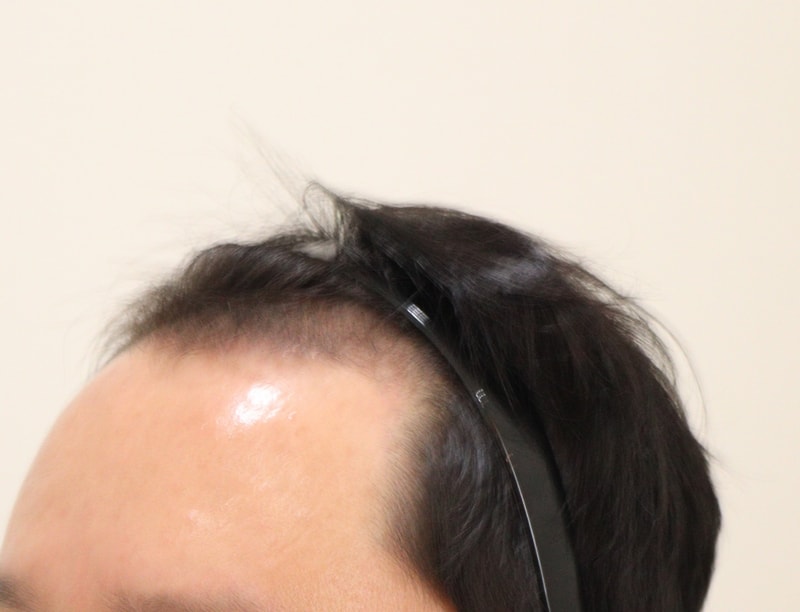 3. 수술후_3개월_2.JPG