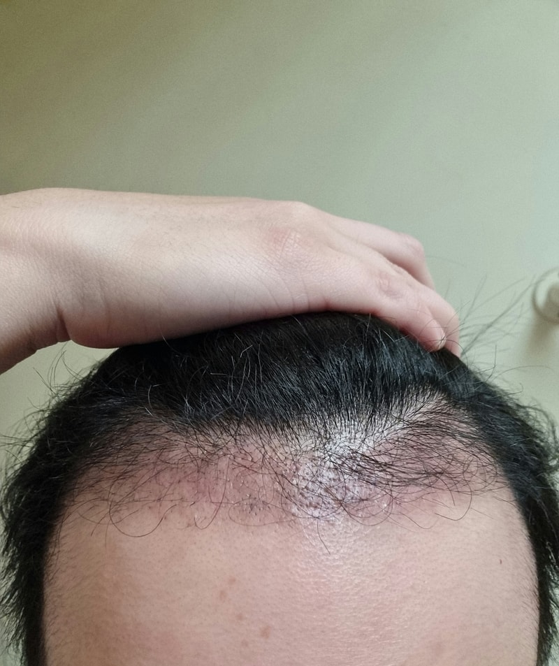 4. 수술후_3개월_셀카_1.jpg