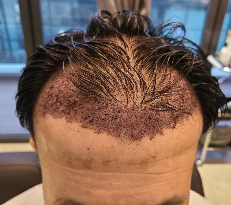 2. 수술후_1일.jpg