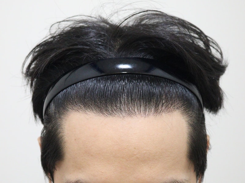 5. 수술후_1년_1.JPG