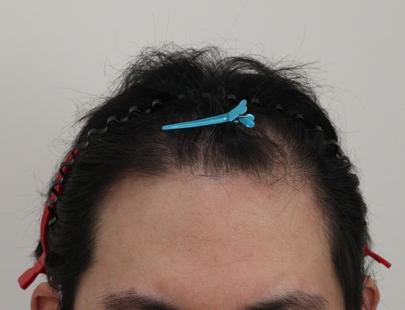 오늘 모발이식했습니다!