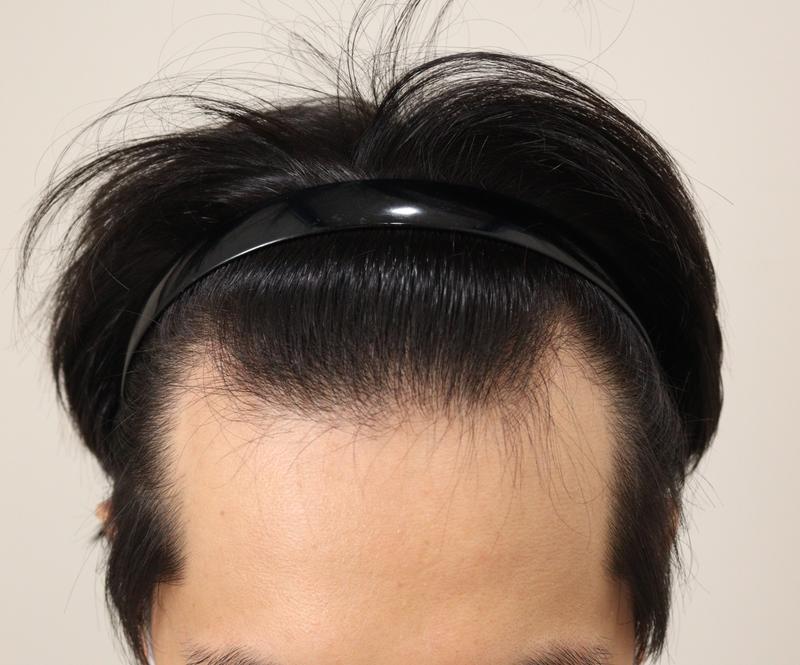 I am sharing the 6 months review of non-cut hair transplantation.