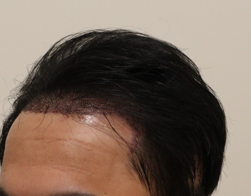 1. 수술후_1일_2.JPG