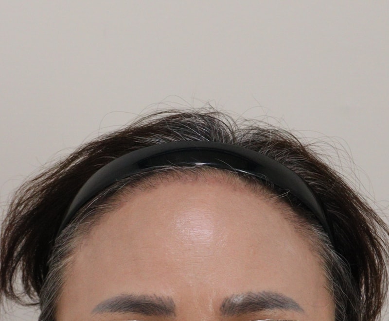 3. 수술후_3개월_1.JPG