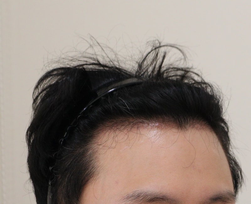 3. 수술후_3개월_3.JPG