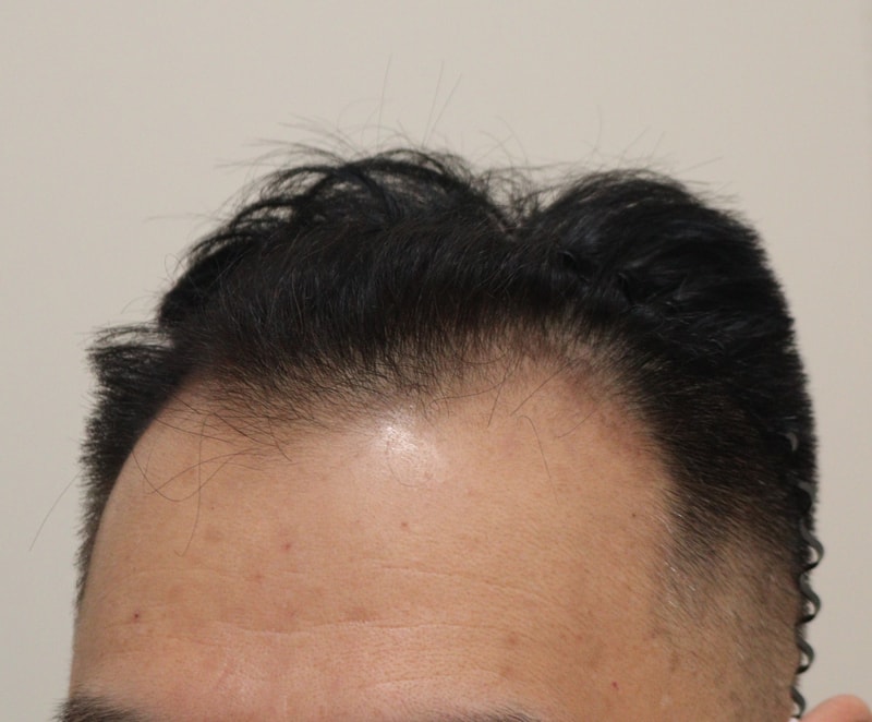 1. 수술전_3.JPG