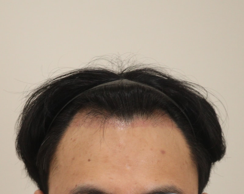 3. 수술후_1개월_1.JPG