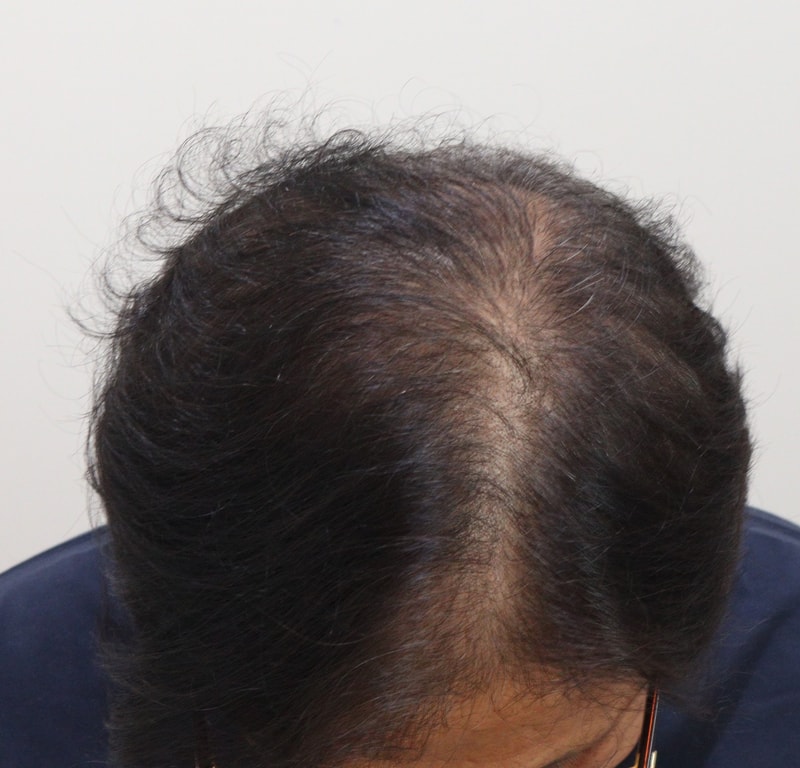 3. 수술후_3개월_3.JPG